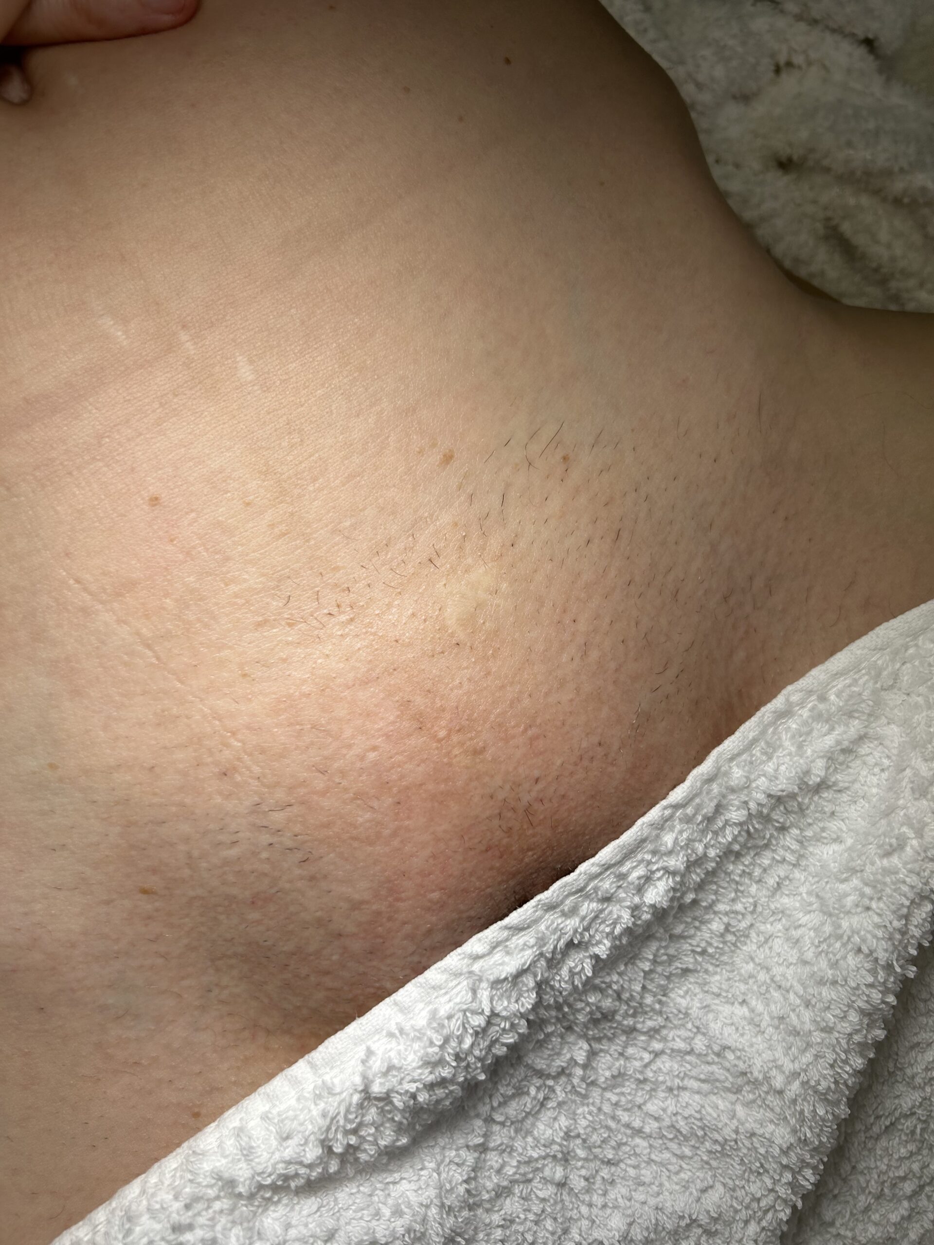 Vorher-Nachher Ergebnis der Laser-Haarentfernung